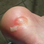 blisters and homeopathy